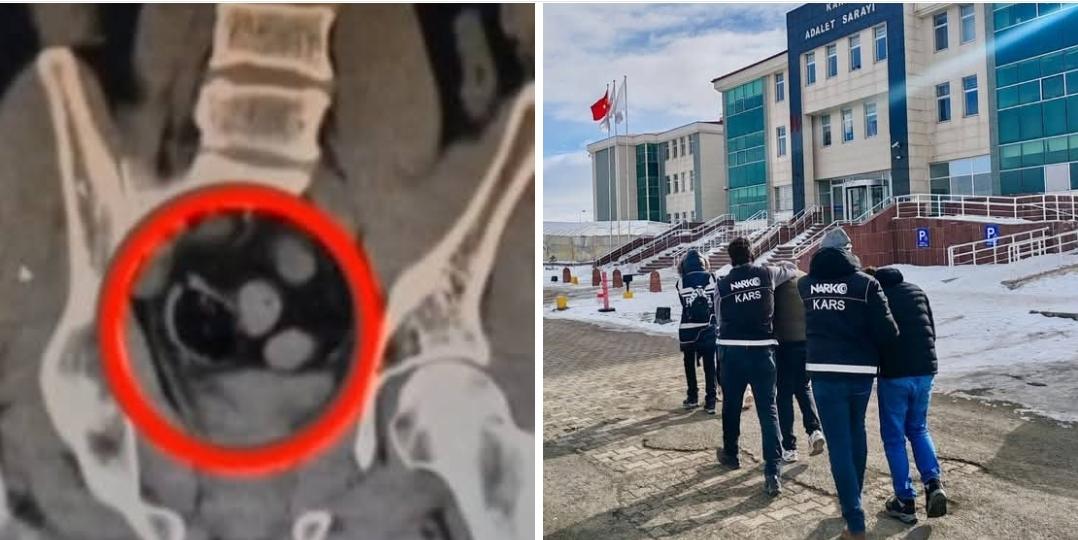 Kars’ta İranlı 3 kişinin bağırsağında uyuşturucu ele geçirildi – Birlik Haber Ajansı